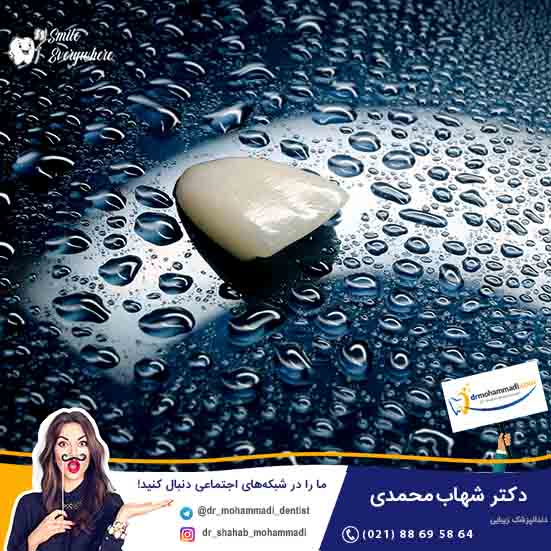 لومینیرز دندان و موارد کاربرد آن - کلینیک دندانپزشکی دکتر شهاب محمدی